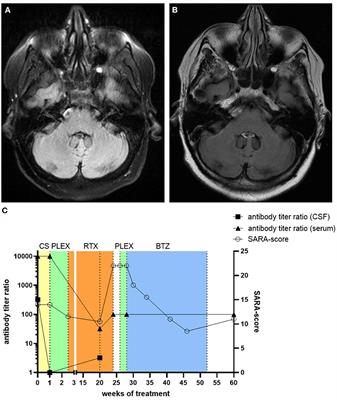 Case report: Anti septin-5-encephalitis as a treatable cause of cerebellar ataxia and psychiatric symptoms